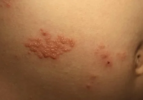 زونا در بارداری