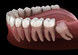 نشانه هایی از درآمدن دندان های عقل