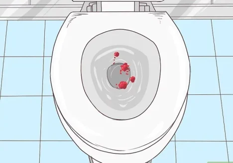 خونریزی مقعد